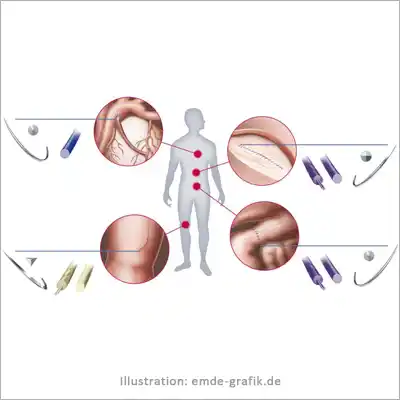 Medizinische Illustration: Einsatz medizinischen Nahtmaterials Unterschiedliche Nadeln und Fäden je nach Einsatzbereich im Körper