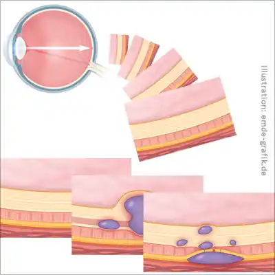 Illustration für Animationsfilm Thema Ophtalmologie