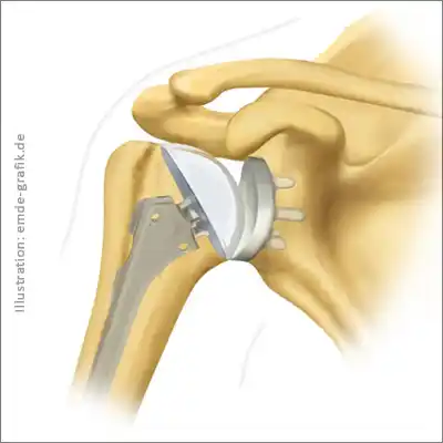 Schultergelenks-Prothese Lage des Implantats