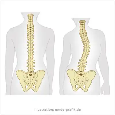 Illustration scoliosis: Healthy and distorted spine