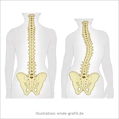 Illustration Skoliose: Gesunde und verkrümmte Wirbelsäule (in Zusammenarbeit mit Georg Stelzner)