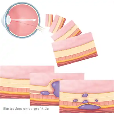 illustrations for an animation: patient information about eye diseases