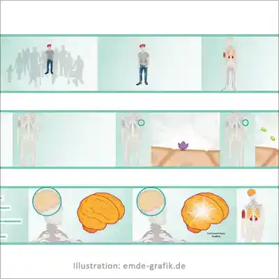 illustrations and animation for information about growth disorder disease hypophosphatasia