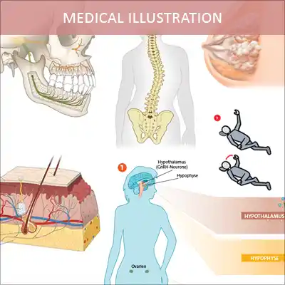 Illustration for medical publications, patient information, presentations, medical therapy and textbooks