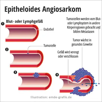 Epitheloides Angiosarkom