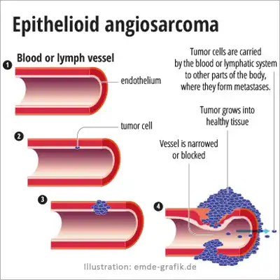 medical illustration: epitheloid angiosarcoma