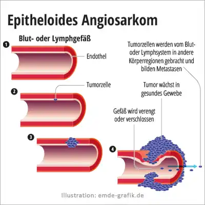 Epitheloides Angiosarkom: Stadien und Auswirkungen der Erkrankung