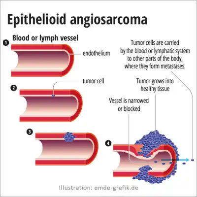 epithelioid angiosarcoma: Stages and effects of the disease